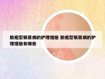 脓疱型银屑病的护理措施 脓疱型银屑病的护理措施有哪些