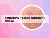 白斑和汗斑的图片出来区别 白斑与汗斑的区别是什么?