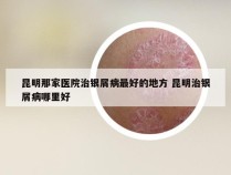 昆明那家医院治银屑病最好的地方 昆明治银屑病哪里好