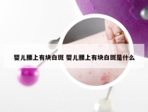 婴儿腰上有块白斑 婴儿腰上有块白斑是什么