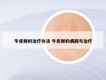 牛皮鲜的治疗办法 牛皮鲜的病因与治疗