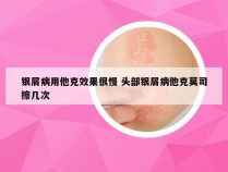 银屑病用他克效果很慢 头部银屑病他克莫司擦几次