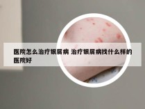 医院怎么治疗银屑病 治疗银屑病找什么样的医院好