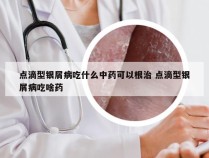 点滴型银屑病吃什么中药可以根治 点滴型银屑病吃啥药