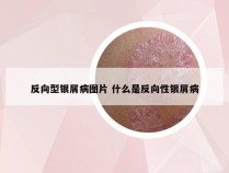 反向型银屑病图片 什么是反向性银屑病