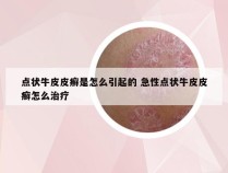 点状牛皮皮癣是怎么引起的 急性点状牛皮皮癣怎么治疗