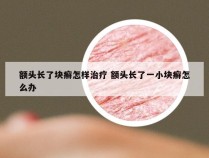 额头长了块癣怎样治疗 额头长了一小块癣怎么办