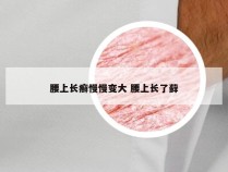 腰上长癣慢慢变大 腰上长了藓