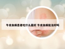 牛皮血癣患者吃什么最好 牛皮血癣能治好吗