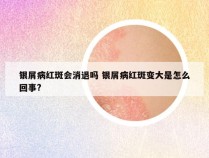 银屑病红斑会消退吗 银屑病红斑变大是怎么回事?