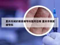 重庆权威的银屑病专科医院在哪 重庆市银屑病专科