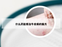 什么药能根治牛皮癣的偏方