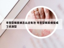 寻常型银屑病怎么还有泡 寻常型银屑病变成了点滴型