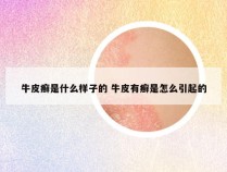 牛皮癣是什么样子的 牛皮有癣是怎么引起的