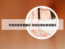 外阴白斑早期图片 妇科白斑的症状图片