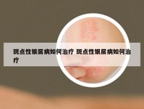 斑点性银屑病如何治疗 斑点性银屑病如何治疗