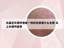 头最近长那种像癣一样的东西是什么东西 头上长癣咋回事