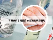 白颠疯的早期图片 白颠疯的初期图片