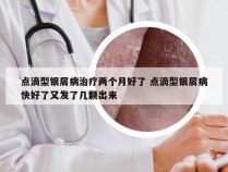 点滴型银屑病治疗两个月好了 点滴型银屑病快好了又发了几颗出来