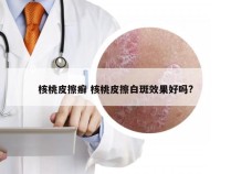 核桃皮擦癣 核桃皮擦白斑效果好吗?