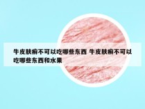 牛皮肤癣不可以吃哪些东西 牛皮肤癣不可以吃哪些东西和水果