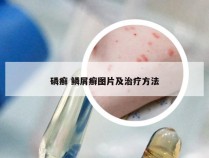 磷癣 鳞屑癣图片及治疗方法