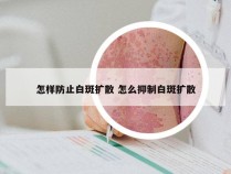 怎样防止白斑扩散 怎么抑制白斑扩散