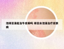 泡绿豆澡能治牛皮癣吗 绿豆水泡澡治疗皮肤病