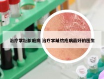 治疗掌趾脓疱病 治疗掌趾脓疱病最好的医生