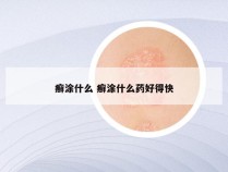 癣涂什么 癣涂什么药好得快