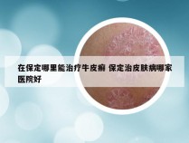 在保定哪里能治疗牛皮癣 保定治皮肤病哪家医院好