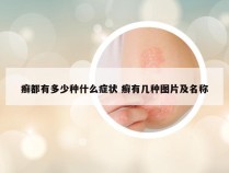 癣都有多少种什么症状 癣有几种图片及名称