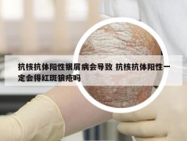 抗核抗体阳性银屑病会导致 抗核抗体阳性一定会得红斑狼疮吗