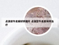 点滴状牛皮癣好转图片 点滴型牛皮屑如何治疗