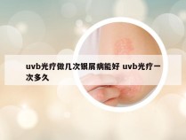 uvb光疗做几次银屑病能好 uvb光疗一次多久