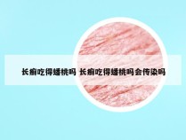 长癣吃得蟠桃吗 长癣吃得蟠桃吗会传染吗