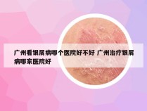 广州看银屑病哪个医院好不好 广州治疗银屑病哪家医院好