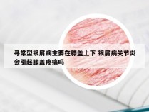 寻常型银屑病主要在膝盖上下 银屑病关节炎会引起膝盖疼痛吗