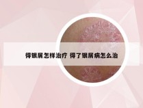 得银屑怎样治疗 得了银屑病怎么治