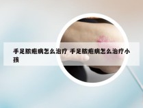 手足脓疱病怎么治疗 手足脓疱病怎么治疗小孩