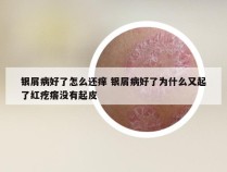 银屑病好了怎么还痒 银屑病好了为什么又起了红疙瘩没有起皮