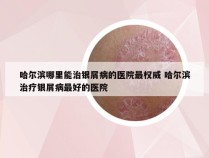 哈尔滨哪里能治银屑病的医院最权威 哈尔滨治疗银屑病最好的医院