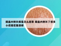 膝盖内侧长癣是怎么回事 膝盖内侧长了很多小疙瘩密集很痒