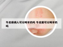 牛皮癣病人可以喝羊奶吗 牛皮廨可以喝羊奶吗