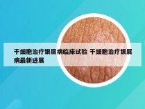 干细胞治疗银屑病临床试验 干细胞治疗银屑病最新进展