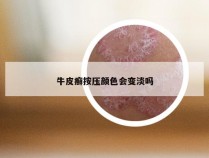 牛皮癣按压颜色会变淡吗