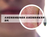 点滴型银屑病复发症状 点滴型银屑病复发率高吗