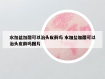 水加盐加醋可以治头皮藓吗 水加盐加醋可以治头皮藓吗图片