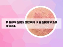 长春那家医院治皮肤病好 长春医院哪家治皮肤病最好