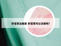 积雪草治银屑 积雪草可以淡斑吗?